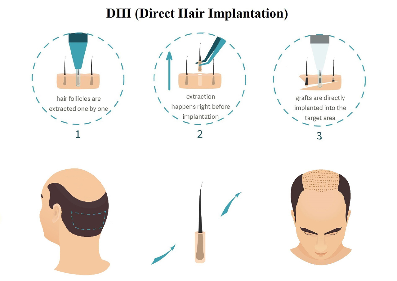 DHI-Methode Haartransplantation