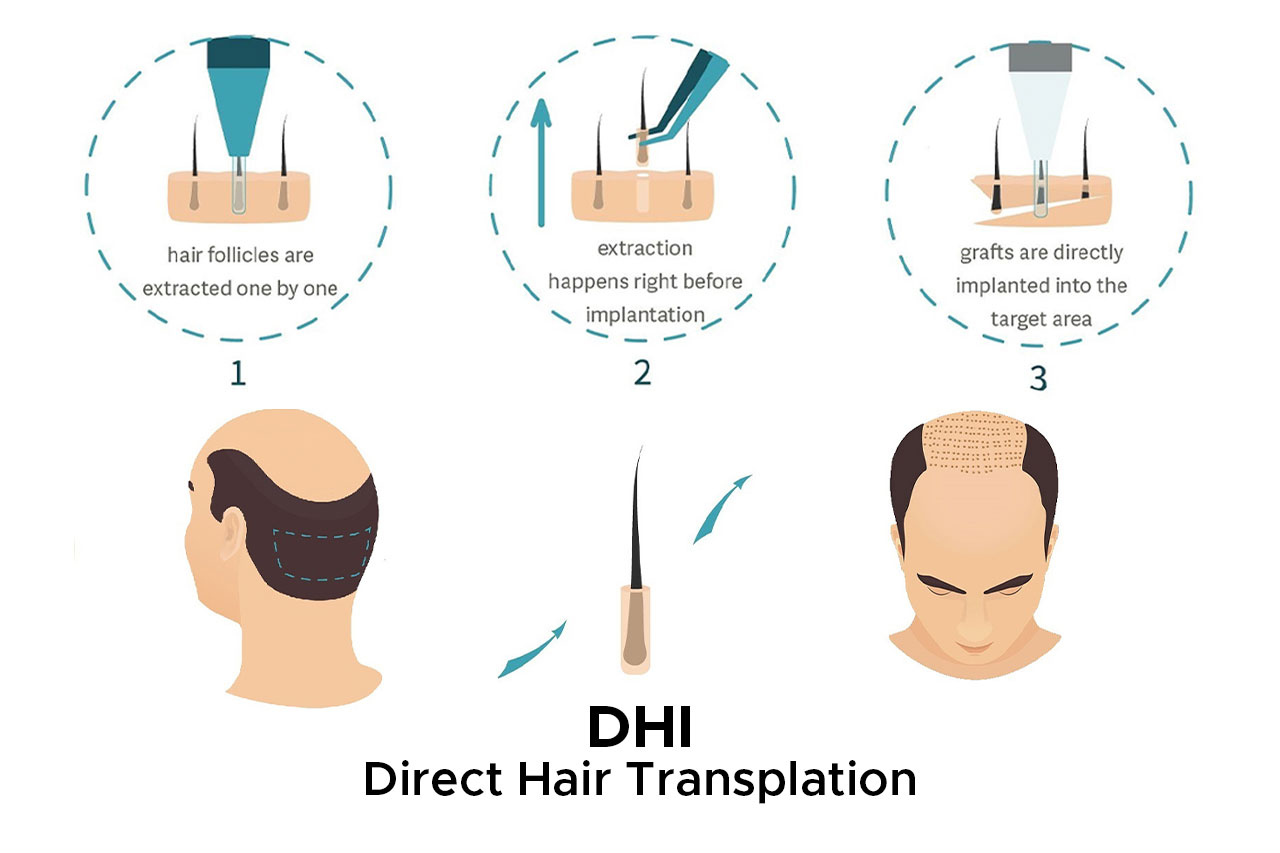 Пересадка волос методом DHI