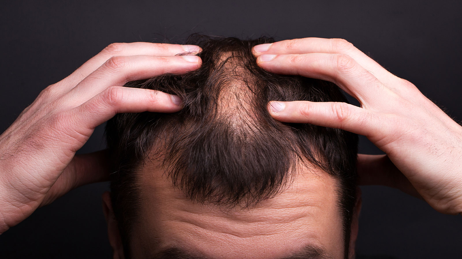 Пересадки Волос - Medworld Hair Clinic