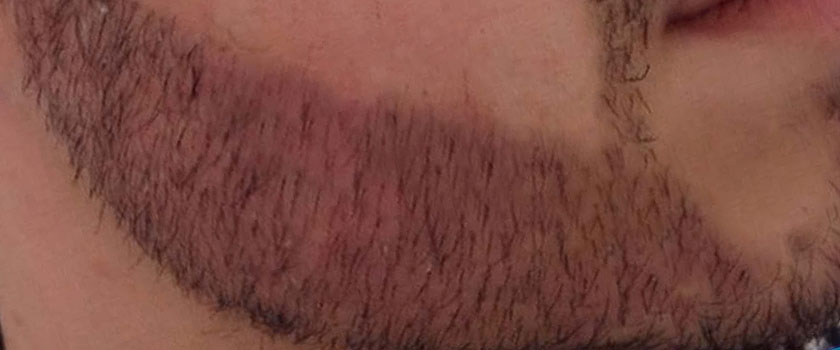 Трансплантация волос на бороду